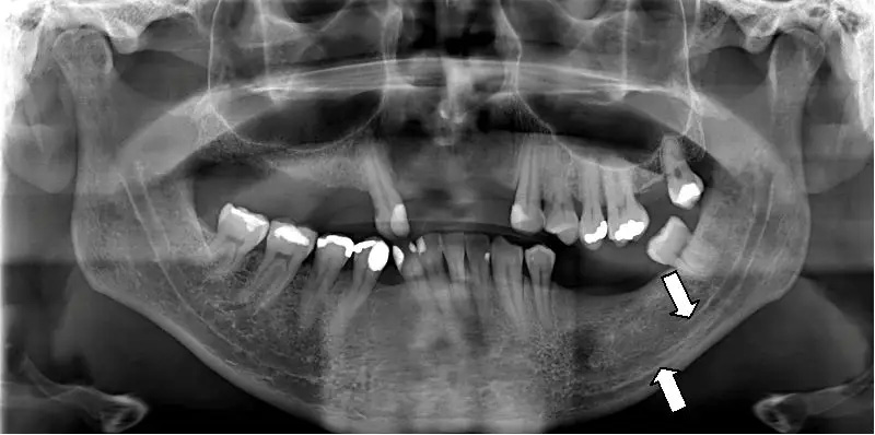 Ceramic Dental Crowns near Modesto