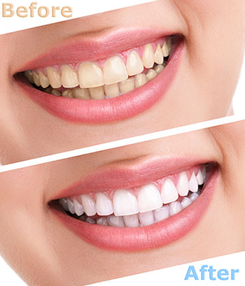Wayne T. Yee, DDS | Ceramic Crowns, Teeth Whitening and Veneers